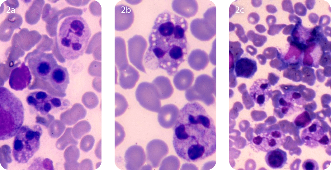 Uncover WHIM Syndrome Mechanisms CXCR4 Dysregulation + Myelokathexis
