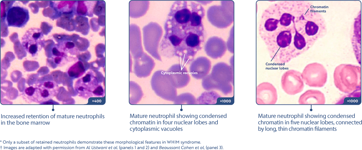 WHIM Myelokathexis Biopsy Image